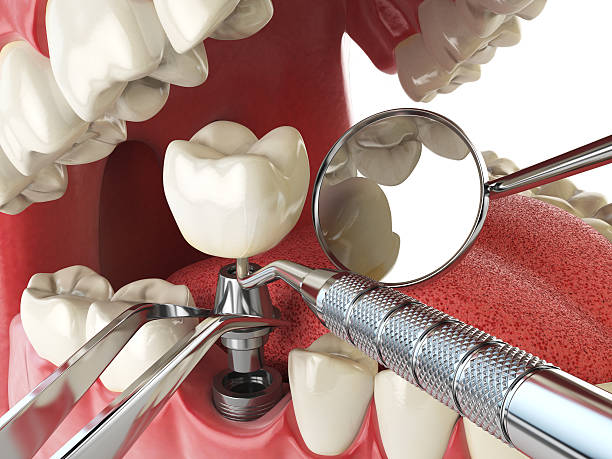 Best Knocked-Out Tooth (Avulsed Tooth) Treatment in Liberty, UT